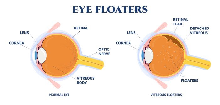 Mengapa eye floaters