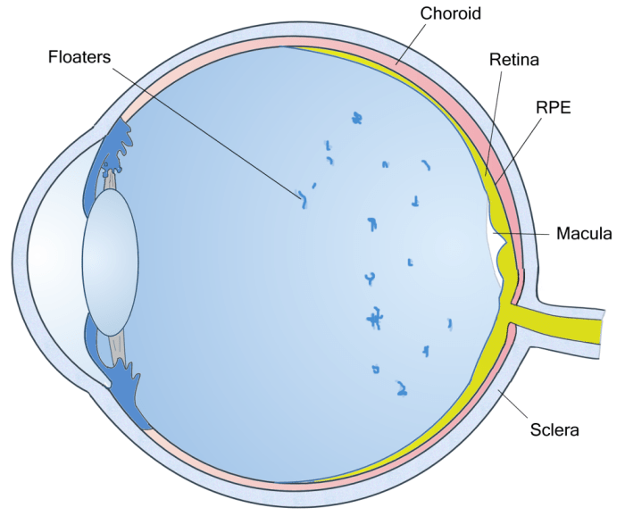 Mengapa eye floaters