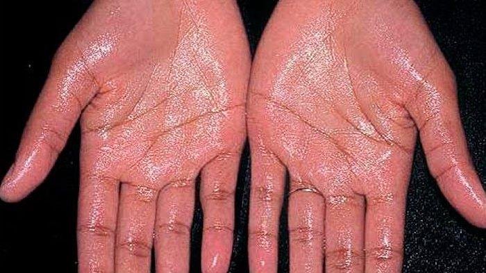 Alasan telapak tangan berkeringat saat gugup